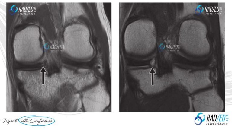 MENISCAL OSSICLES MRI: POSTERIOR HORN MENISCUS (Updated 2021) - Radedasia