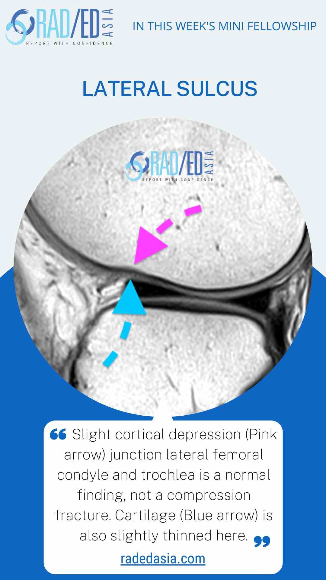 lateral sulcus knee mri acc tear osteochondral fracture radedasia