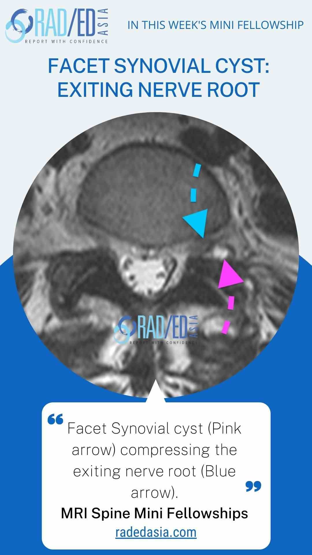 mri facet synovial cyst exiting nerve rootradedasia