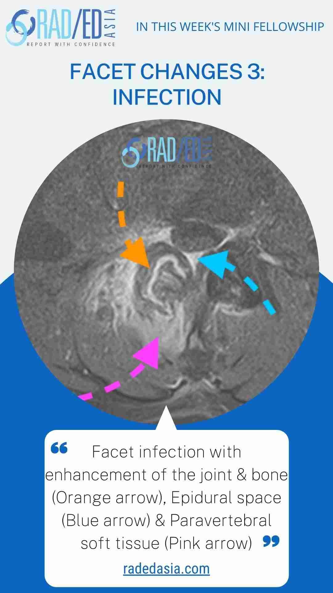 mri spine facet infection epidural space radedasia