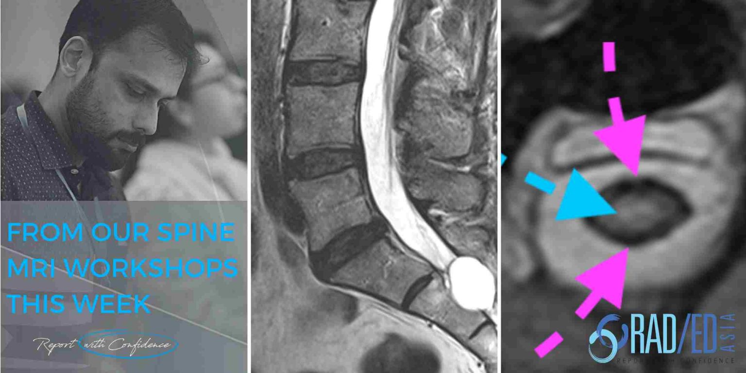 SPINE MRI NERVE ROOT COMPRESSION ONLINE RADIOLOGY COURSE Radedasia