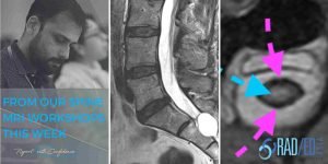 arachnoiditis spine mri online radiology courses radedasia
