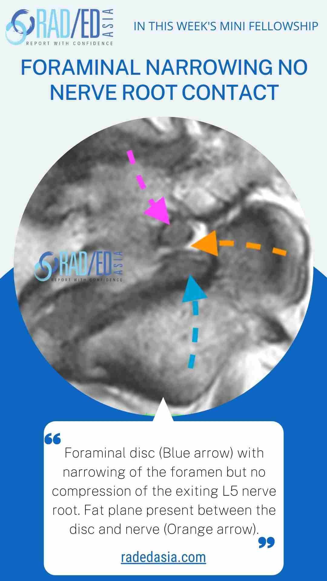 foraminal narrowing no nerve root contact radedasia