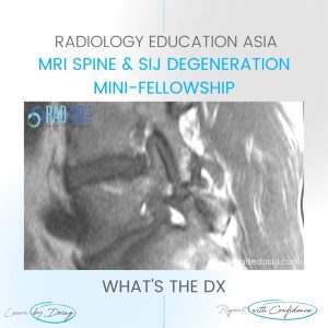 pars defect radiology mri radedasia