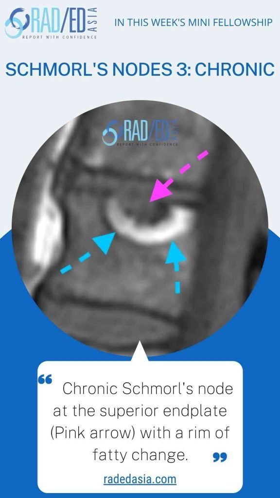 SCHMORL'S NODES SPINE MRI ONLINE RADIOLOGY COURSE LEARN KEY POINTS