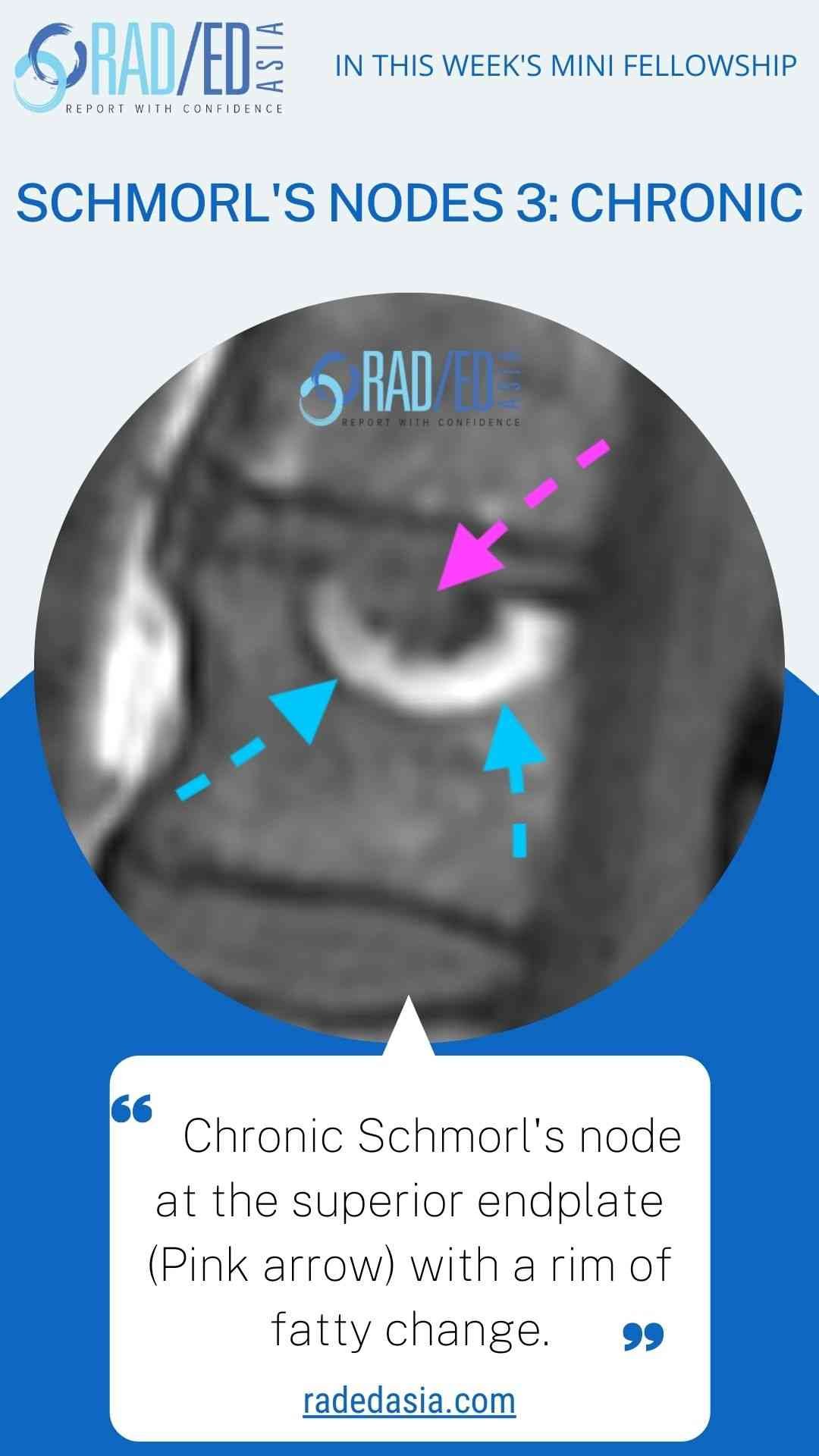 schmorl's node chronic spine mri radedasia