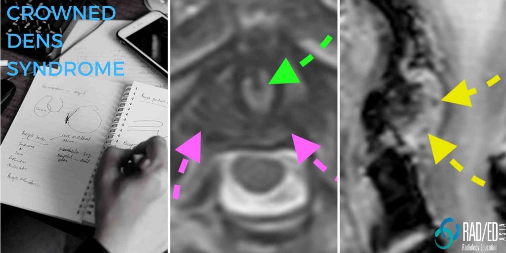 cppd crowned dens ct mri spine mri online radiology courses calcium pyrophosphate deposition