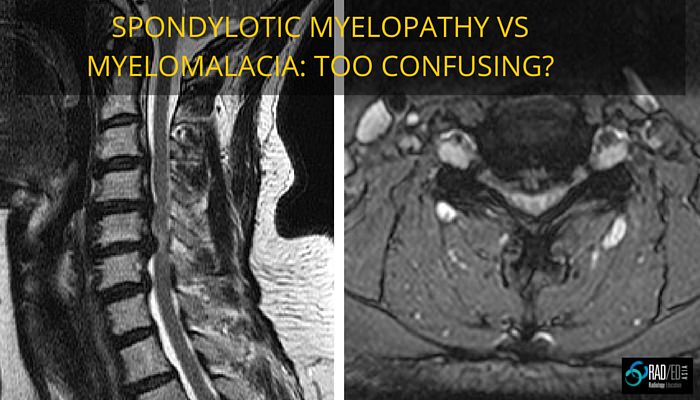 myelomalacia-spondylotic-myelopathy-radiology-education-asia