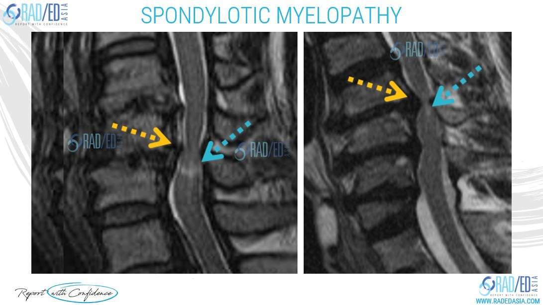spondylotic-myelopathy-mri-radiology-education-radedasia-image 1