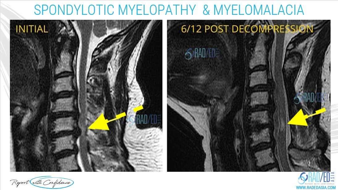 spondylotic-myleopathy-myelomalacia-mri-radiology-education-radedasia-image 3