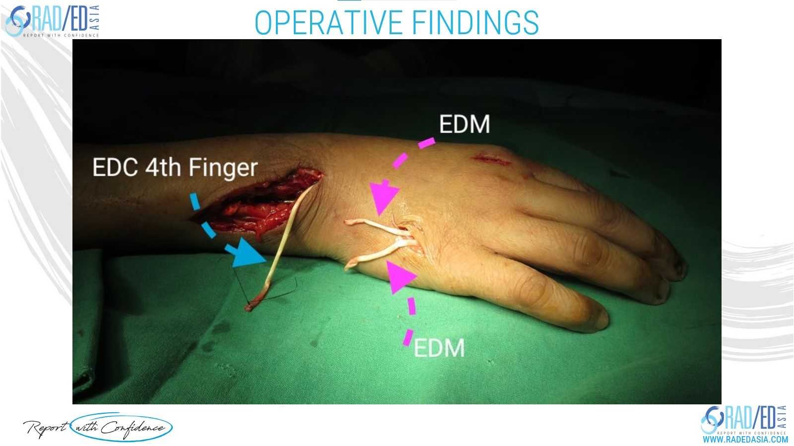 wrist rheumatoid arthritis Vaughn Jackson Syndrome finger operative findings radedasia