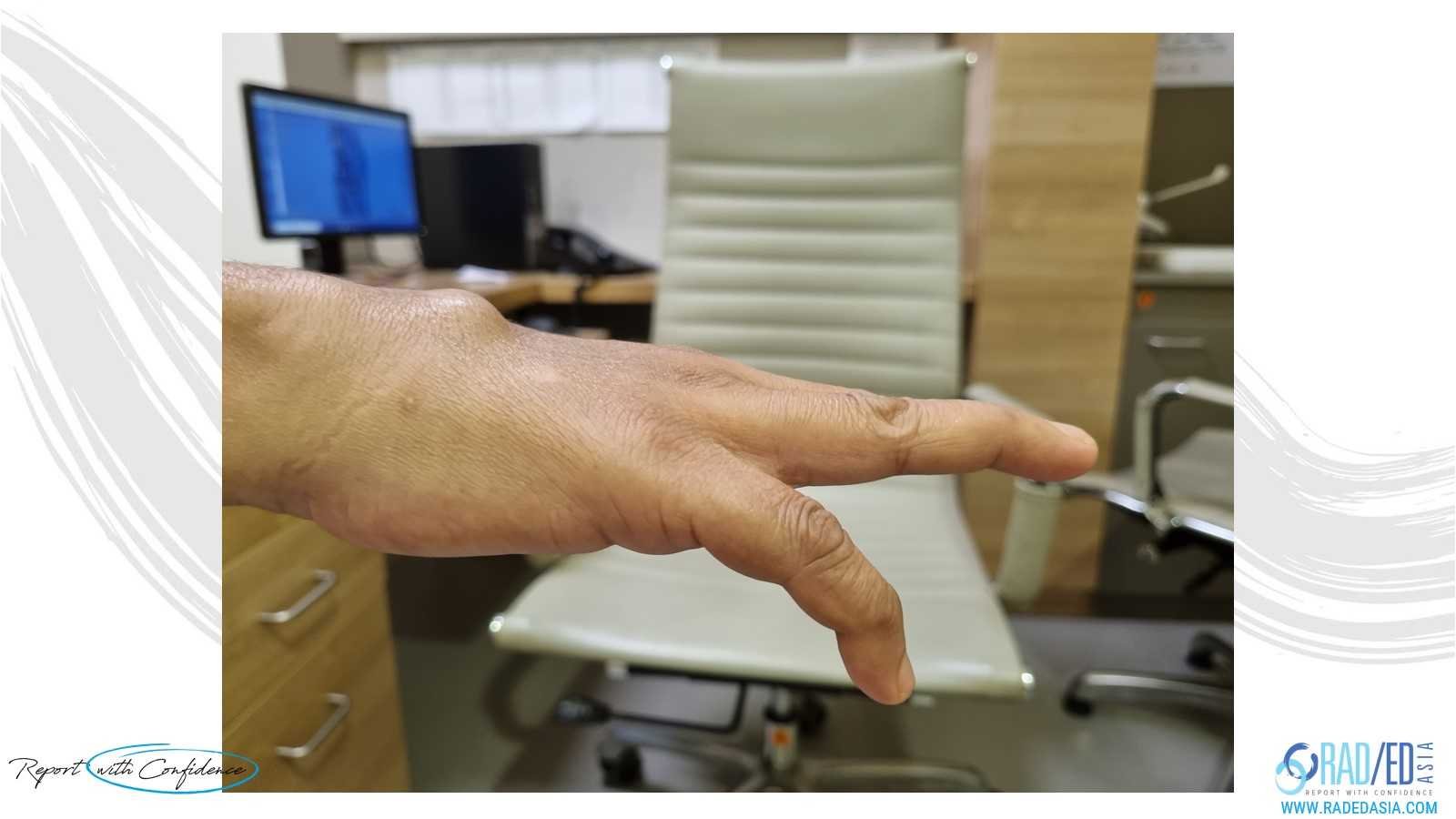 wrist rheumatoid arthritis Vaughn Jackson Syndrome wrist clinical radedasia