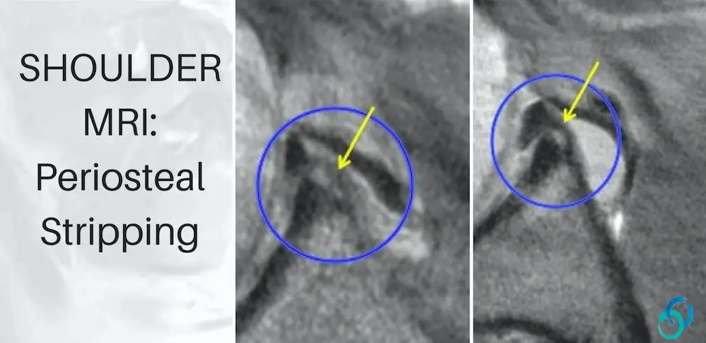 shoulder-mri-periosteum-stripping-scarring-radedasia-radiology-education-retraction