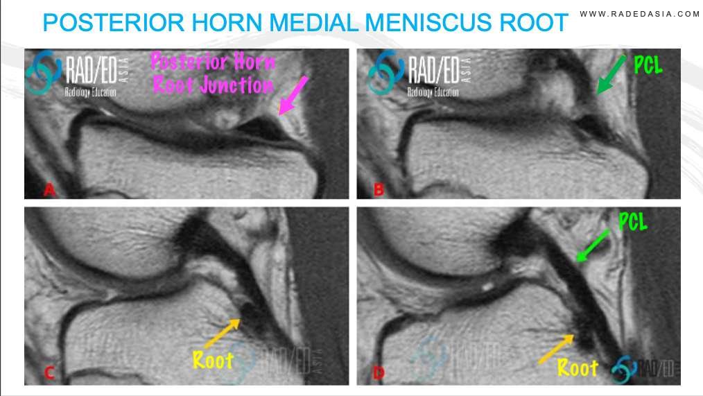 knee mri meniscus root tear anatomy