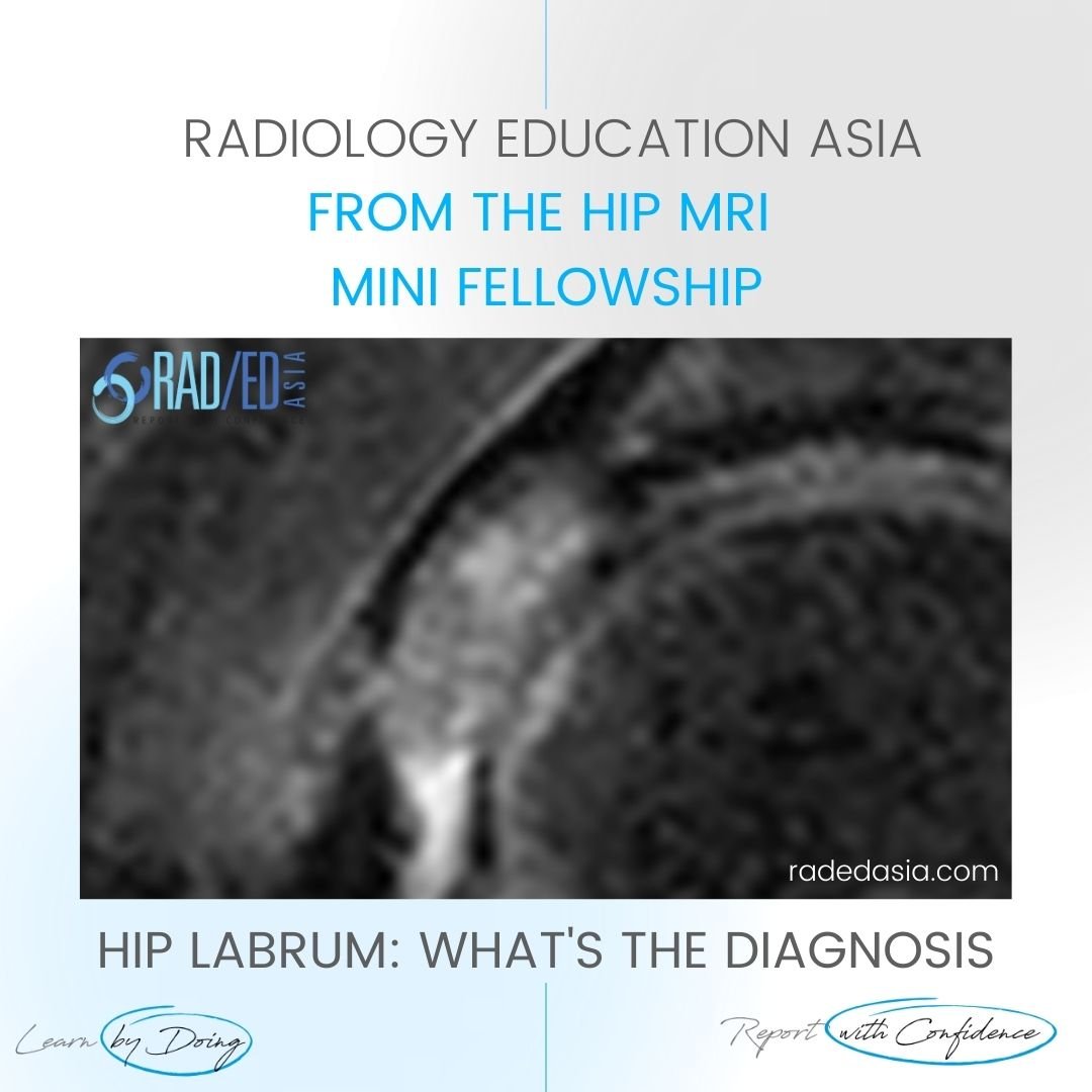 learn mri radiology hip labrum mucoid degen radedasia
