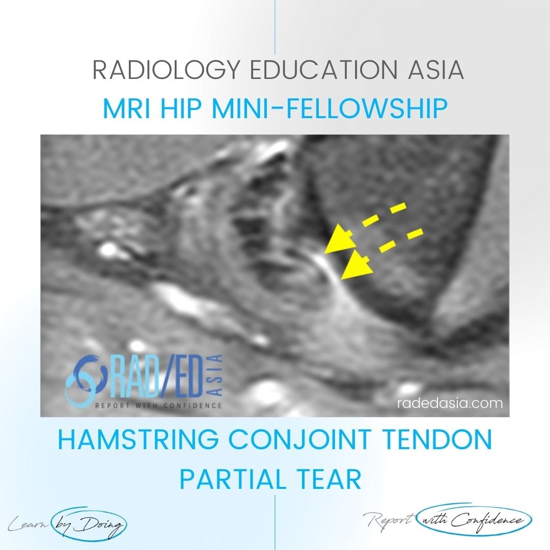 mri hamstring tendinopathy tear tendon hip
