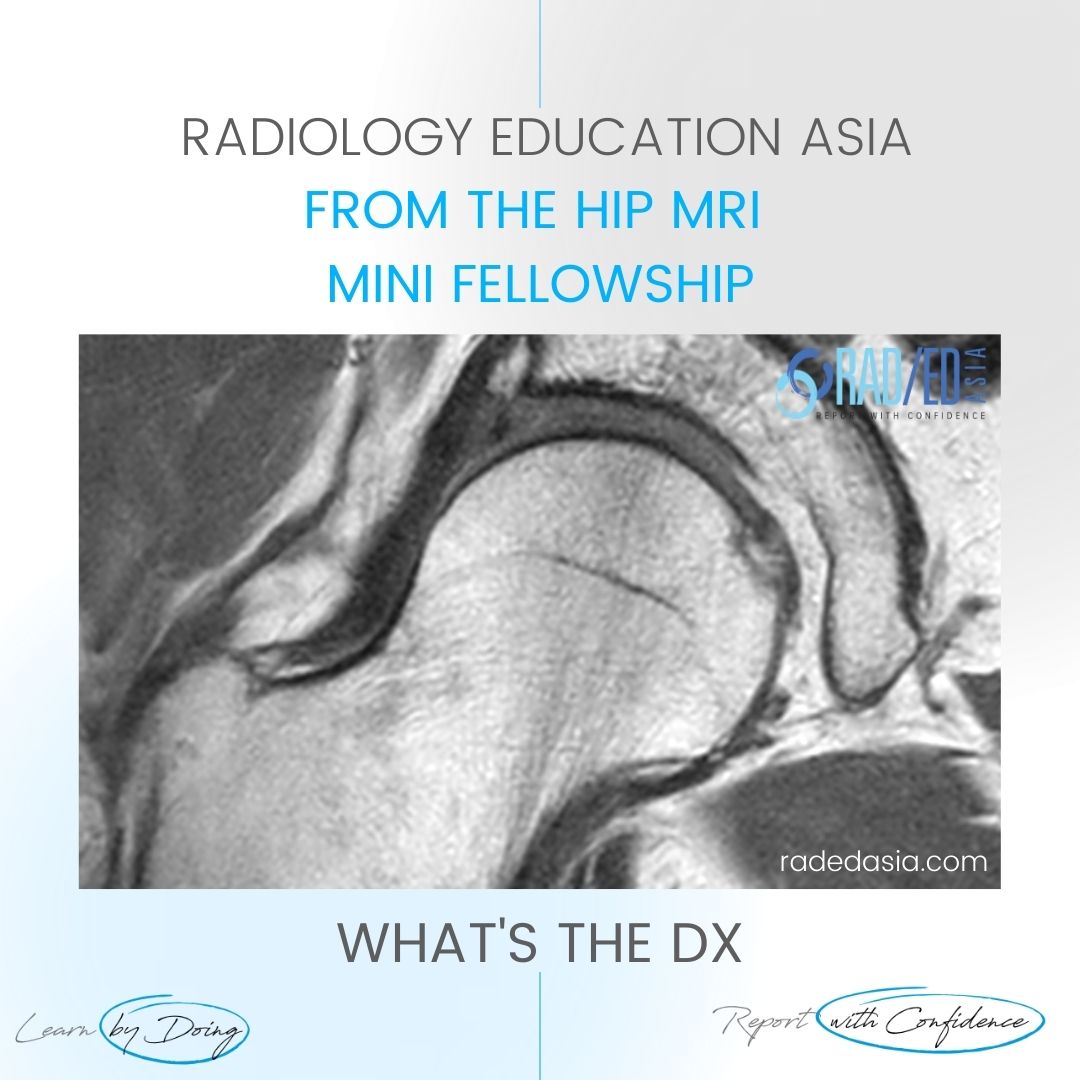 mri hip cam fai femoro acetabular impingement rea