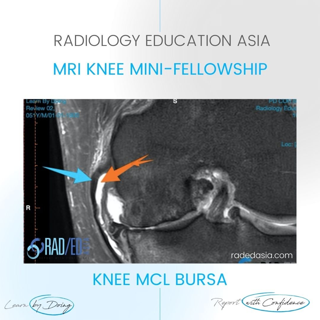 mri knee mcl medial collateral ligament mcl bursa