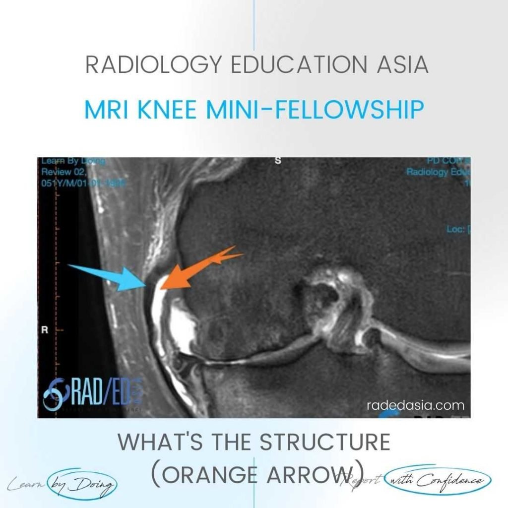 mri knee medial collateral ligament mcl bursa