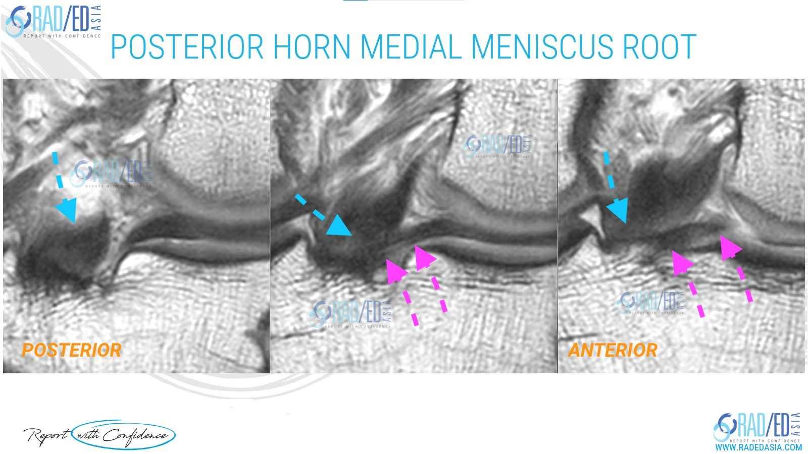 mri knee post horn medial meniscus root radedasia