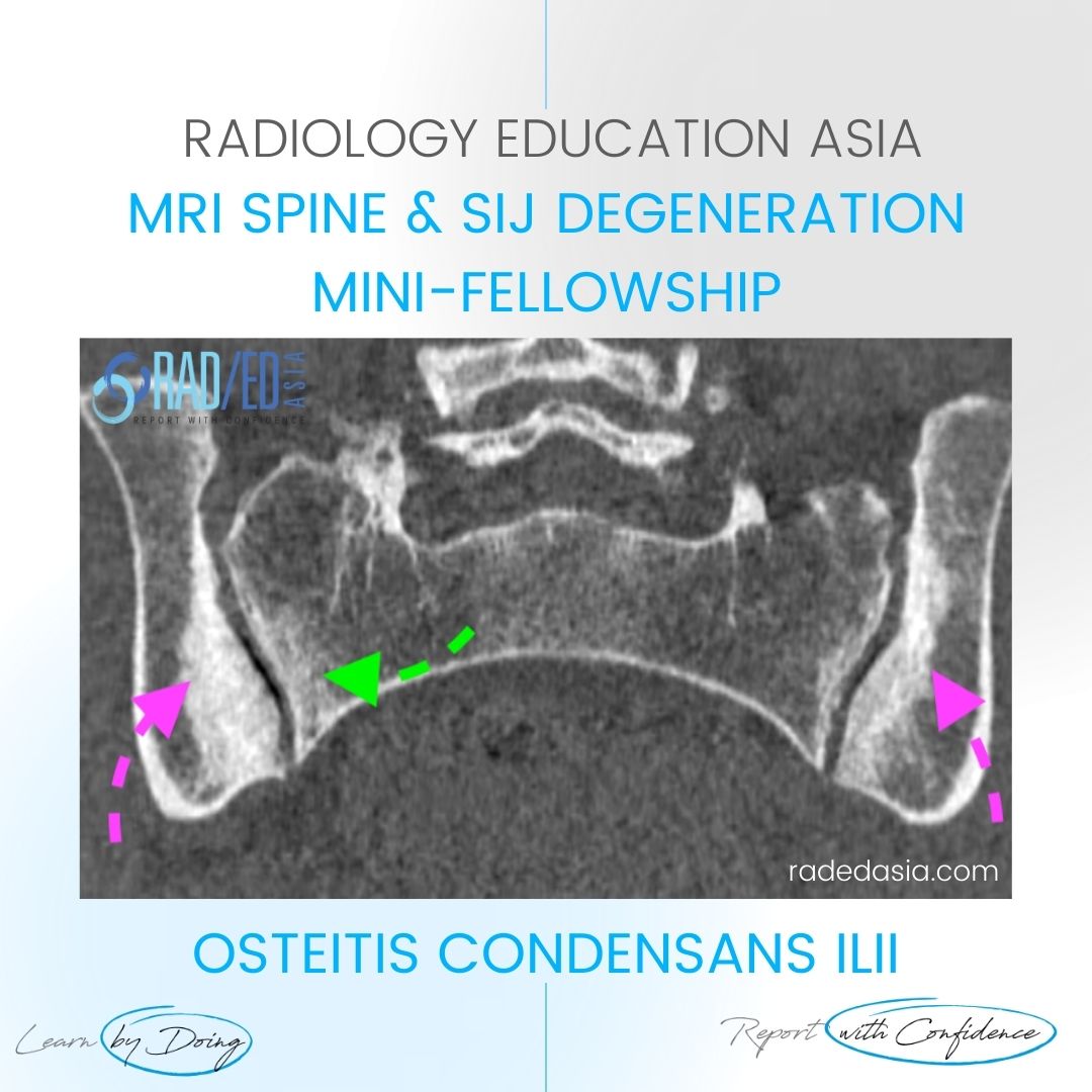 OSTEITIS CONDENSANS ILII RADIOLOGY CT SACROILIAC JOINT SIJ - Radedasia