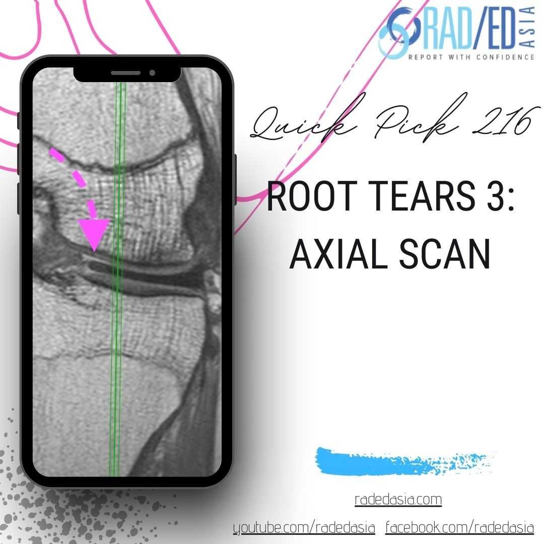 knee mri root tears axial scan radedasia