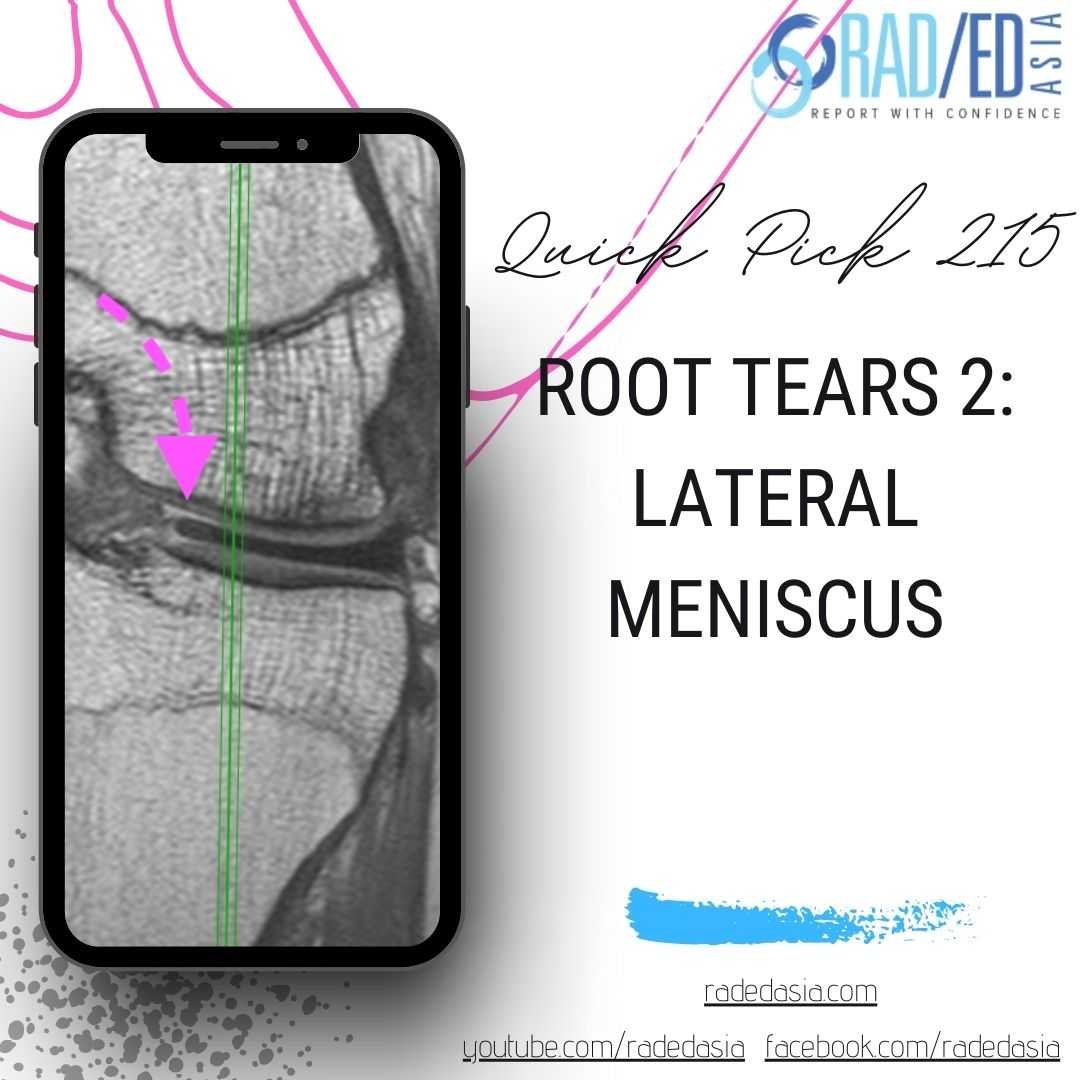 knee mri root tears lateral meniscus radedasia
