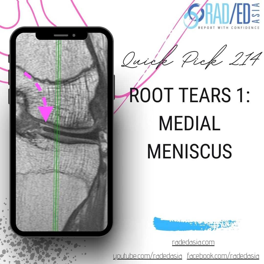 knee mri root tears medial meniscus radedasia