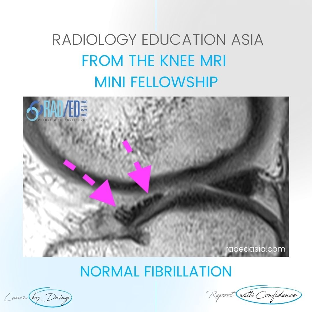 learn knee mri normal fibrillation radedasia
