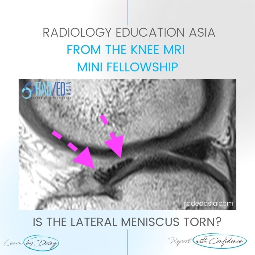 learn knee mri torn meniscus radedasia