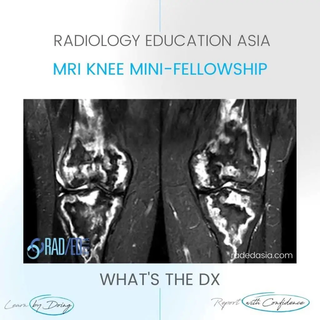 medullary infarct radiology femur tibia mri radedasia