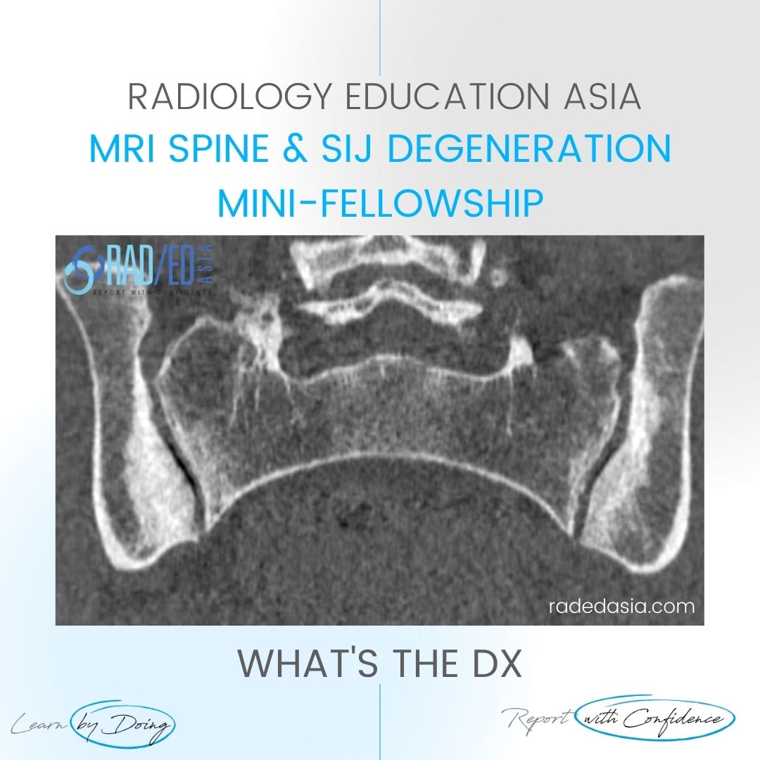 OSTEITIS CONDENSANS ILII MRI SPINE RADIOLOGY VIDEO Radedasia