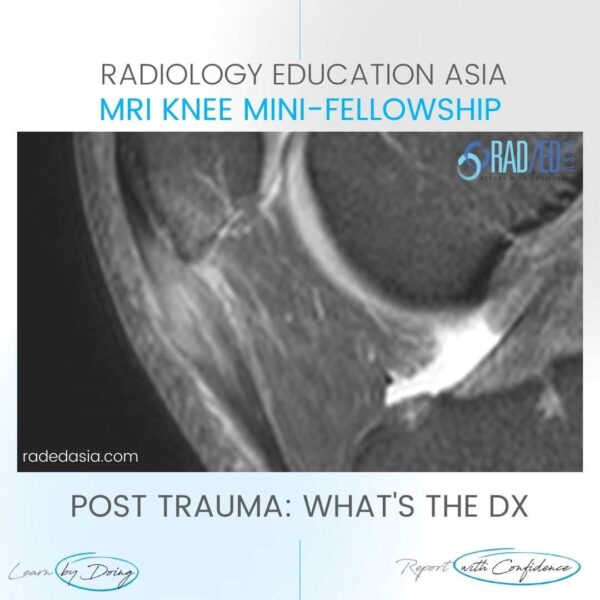 patellar tendon trauma contusion mri