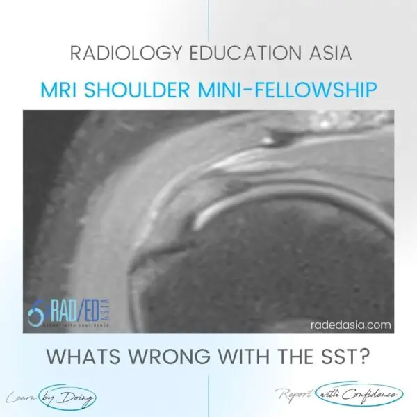 rotator cuff tendinitis mri supraspinatus tendinosis bursitis radiology