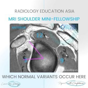 shoulder labrum normal variant buford complex sublabral foramen hole mri