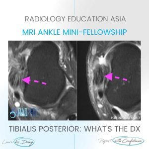 tibialis posterior tendinitis tendinopathy tear mri radiology