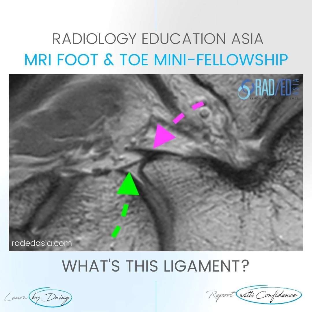 bifurcate ligament radiology anterior mri anatomy