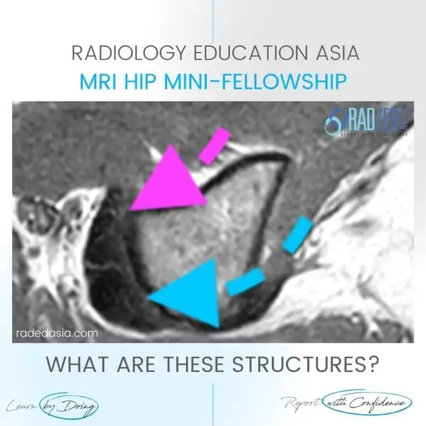 hamstring tendon mri anatomy origin conjoined conjoint tendon origin tendinitis tendonosis rea