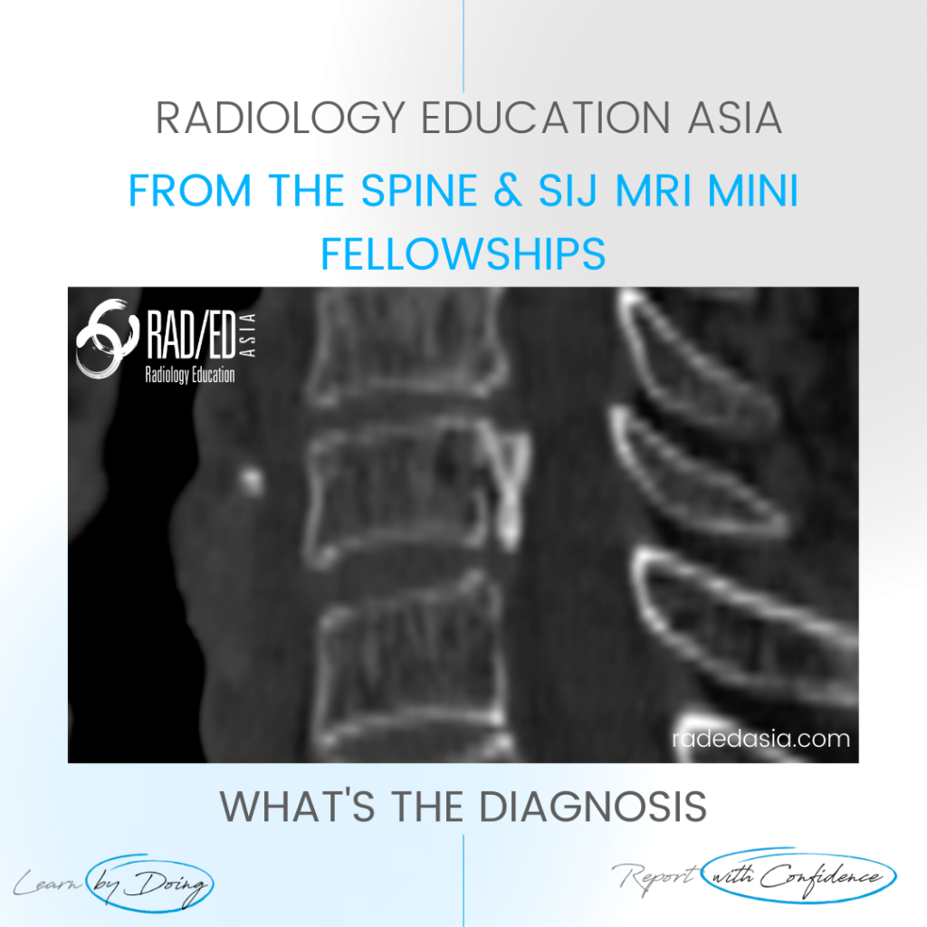 opll spine ossification posterior longitudinal ligament ct mri xray radiology (1)