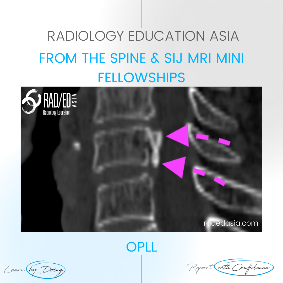 ossification posterior longitudinal ligament opll spinect mri xray radiology