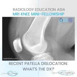 patella dislocation subluxation fracture hemarthrosis lipohemarthrosis radiology mri xray knee