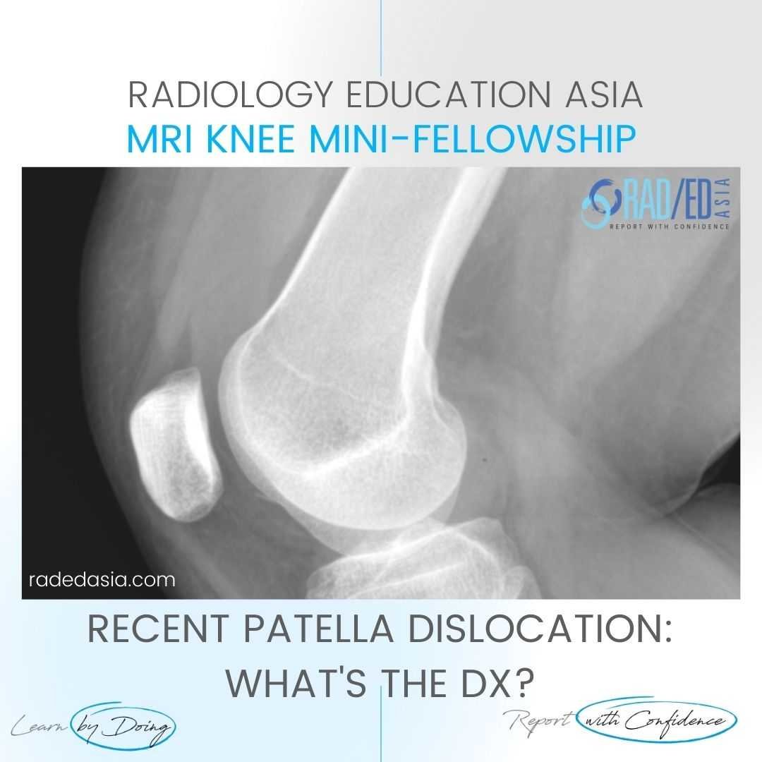 patella dislocation subluxation fracture hemarthrosis lipohemarthrosis radiology mri xray knee