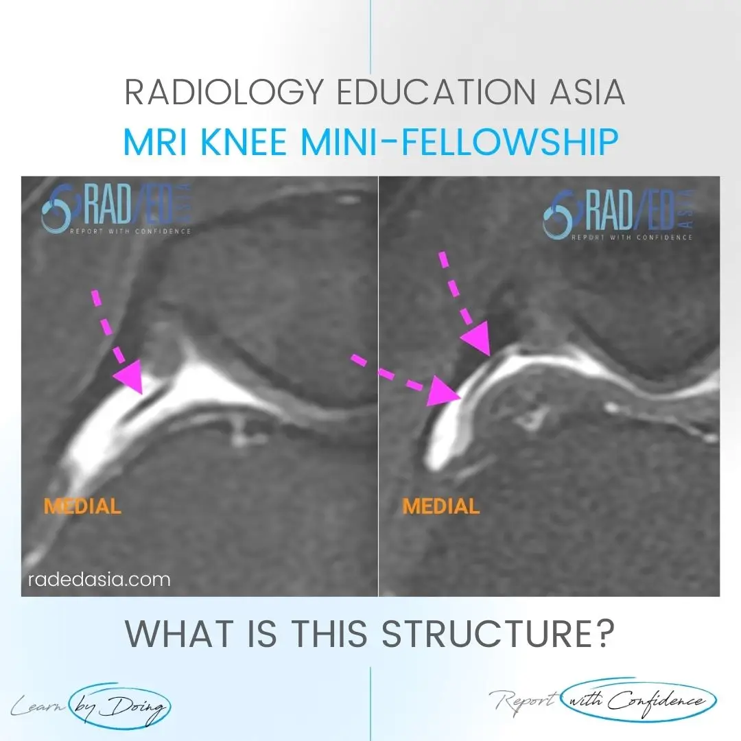 patella plica mri radiology syndrome knee medial radedasia