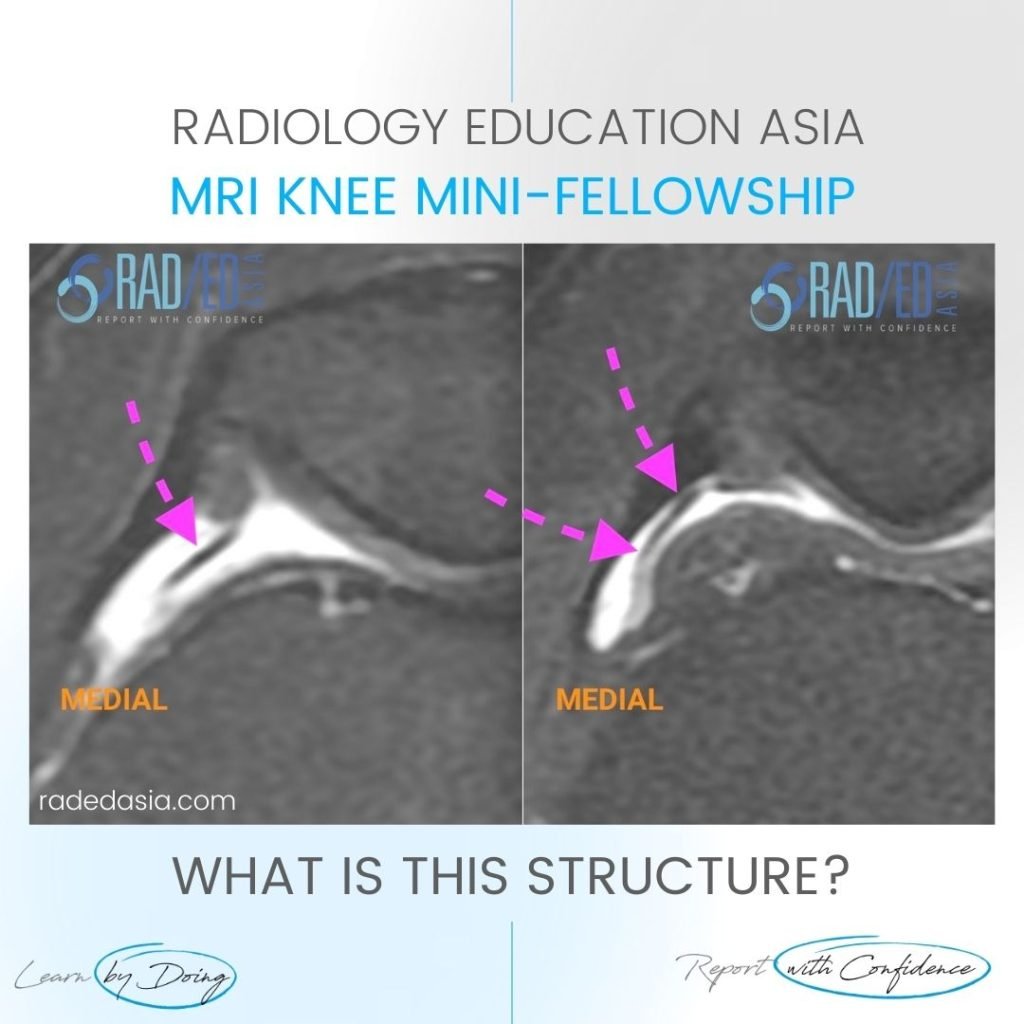 patella plica mri radiology syndrome knee medial radedasia