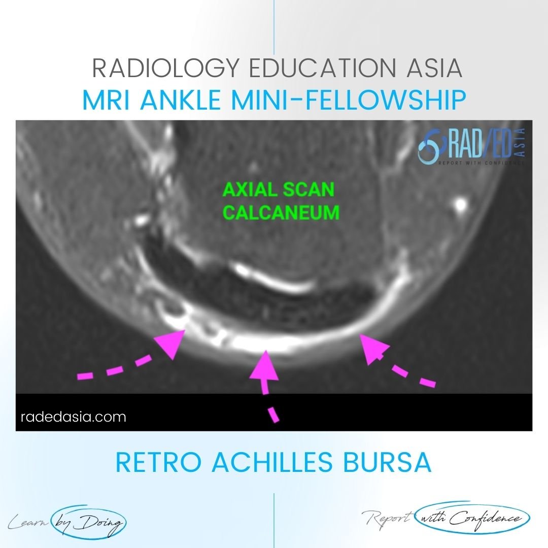 retroachilles bursitis bursa mri radiology ankle