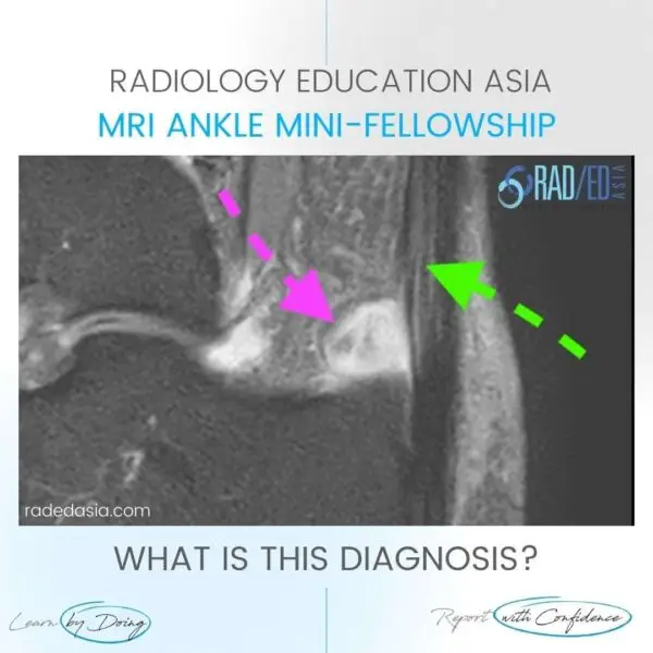 retrocalcaneal bursa bursitis achilles tendon mri radiology radedasia