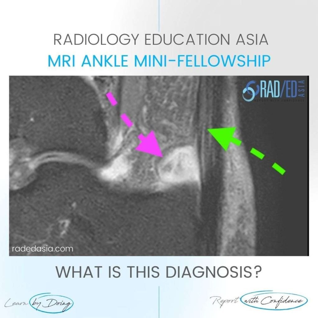 retrocalcaneal bursa bursitis achilles tendon mri radiology radedasia