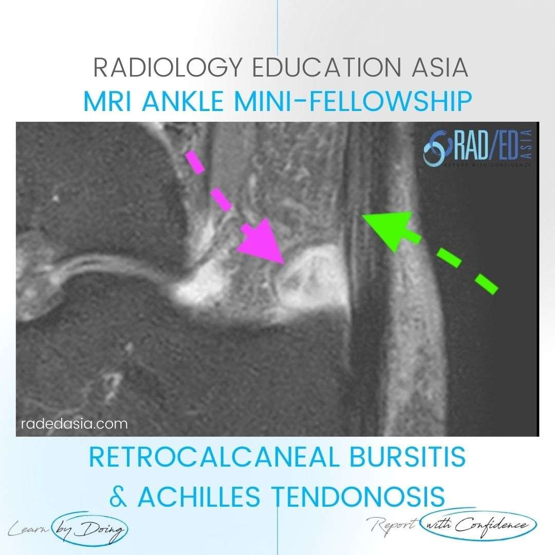 retrocalcaneal bursitis bursa achilles tendon mri radiology radedasia