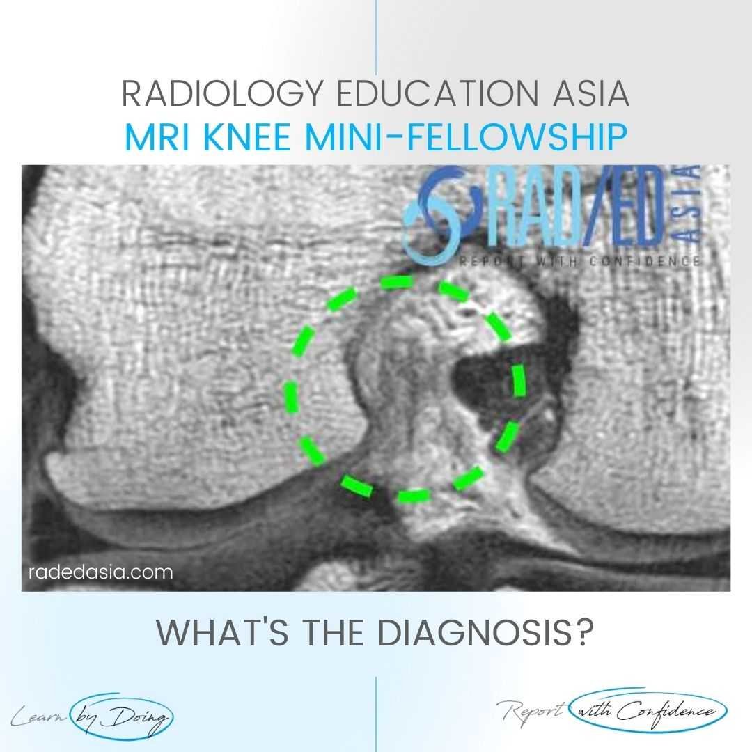 acl tear mri findings knee full thickness coronal radiology radedasia
