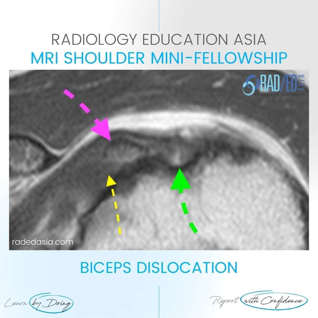 biceps dislocation mri shoulder radiology